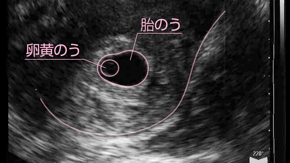 妊娠 5 週 目 エコー