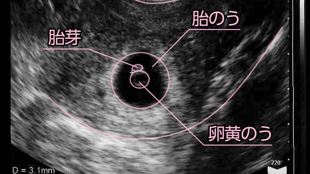 妊娠 6 週 胎嚢 大き さ(02)