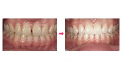 最新のラミネートべニア治療 [歯・口の病気] All About